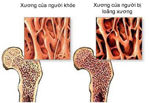 Thuốc lá có thể gây loãng xương.